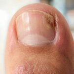 orivelle fungus remove